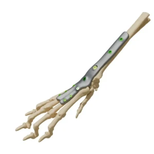 AAP - plate for wrist arthrodesis - Image 1