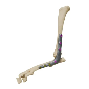 PAP - plate for arthrodesis of the mouldy subglobe - Image 1