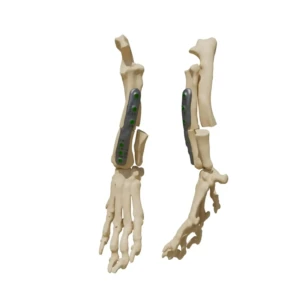 RCP - plate for correction of forearm deformities - Image 1