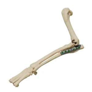TER - Arthroplasty of the elbow joint - Image 1