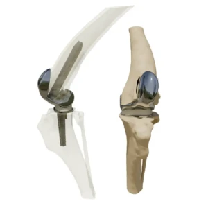 TKR - Knee replacement (arthroplasty) - Image 1